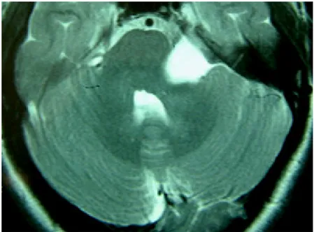 Fig n°11 : Une IRM cérébrale en coupe axiale pondérée en T2 montrant une lésion de  l’APC gauche en hypersignal (kyste épidermoïde)