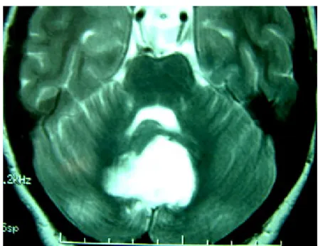 Fig n°12 : Une IRM cérébrale en coupe axiale pondérée en T2  montrant une lésion  vermienne en hypersignal (un kyste épidermoïde)