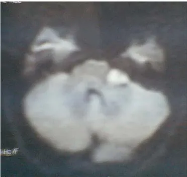 Fig n°14 : Une imagerie de diffusion en coupe axiale: une lésion hyperintense de l’APC gauche  (kyste épidermoïde)