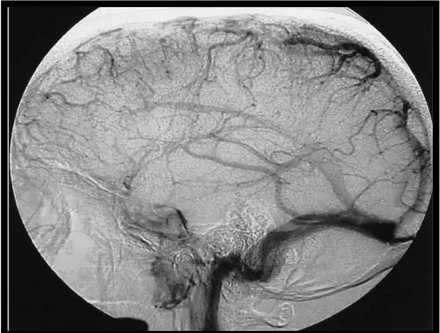 Fig.    34 34 34 34    :  :  : défaut d’opacification du SSS avec circulation de suppléance corticale visible   :  sur une incidence sagittale 