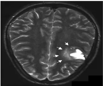 Fig.    25 25 25 25::::infarctus  hémorragique  cortico-sous-cortical  (en  hypersignal)  entouré  d’une 