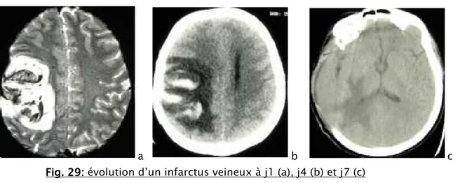 Fig.    29 29 29::::    évolution d’un infarctus veineux à j1 (a), j4 (b) et j7 (c)   29 après une craniectomie décompressive