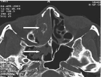 Figure 5a : Coupe TDM axiale en fenêtre osseuse. La tumeur s’étend vers les cellules  éthmoïdales du coté droit