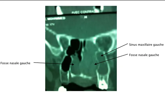Figure 5d : Coupe TDM coronale. Masse comblant la fosse nasale gauche,   sinus maxillaire Et étendue vers la fosse nasale droite