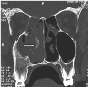 Figure 10 : Coupe TDM coronale en fenêtre osseuse.   Petits débris osseux piégés au sein de la masse (43)