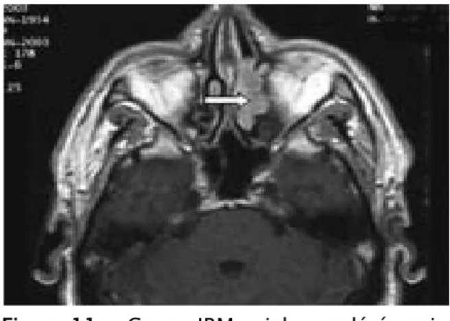 Figure 12a: Coupe IRM axiale pondérée spin  écho T1 après injection de gadolinium (43).