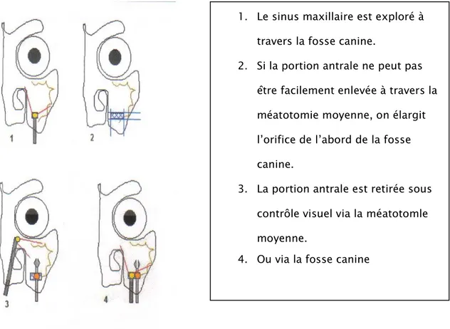 Figure 21 : L’ablation de la portion antrale par la mini Caldwell-Luc  (71).  1.  Le sinus maxillaire est exploré à 