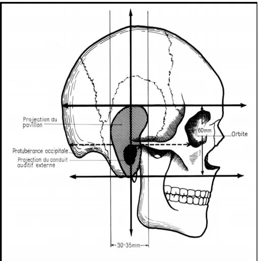 Figure 6. Projection du pavillon de l’oreille droite sur le squelette crânio- facial  (Vue latérale)