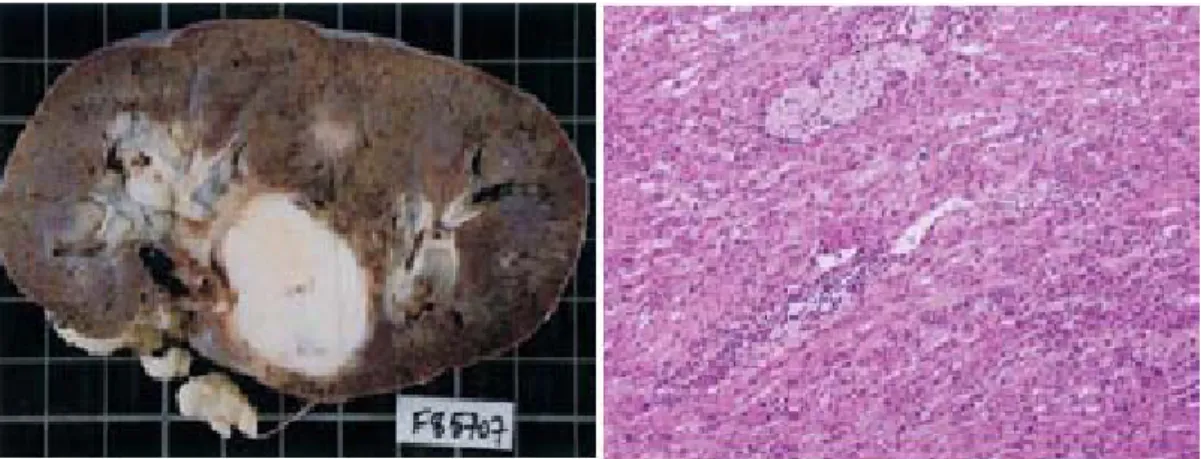 Figure 12 : aspect macroscopique et microscopique d’un carcinome rénal  tubulo-mucineux à cellules fusiformes