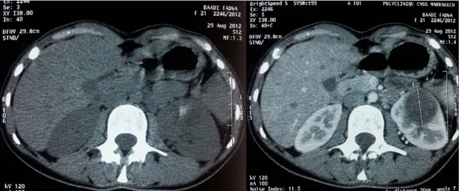 Figure 19 : coupes scannographique transversale avec(droite) et sans(gauche) injection du  produit de contraste qui mettent en évidence un processus tumorale rénale gauche polaire 