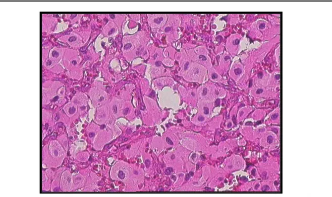 Figure : 14    La prolifération vasculaire et stromale comporte de larges nappes de cellules  xanthélassmisées (HE×400)