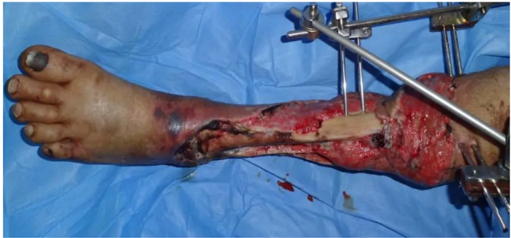 Figure 10 : fracture ouverte de la jambe comminutive   ayant bénéficié d’un fixateur externe 