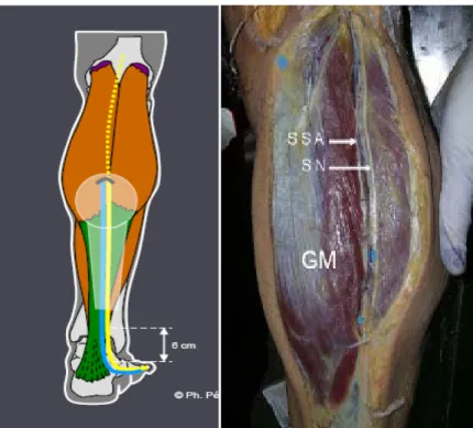 Figure 25 : le nerf sural(SN) chemine entre les 2 chefs du muscle gastrocnémien (GM).Il croise  son artére jumelle(SSA) qui l’accompagne dans son trajet