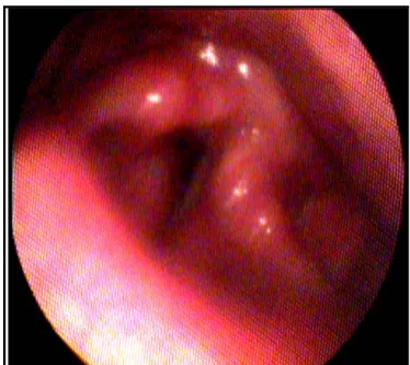 Figure 2 : vue nasofibroscopique d’une paralysie de la corde vocale gauche   post thyroïdectomie avec une aryténoïde basculée en avant 