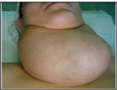 Figure 8 : patiente qui présente un volumineux goitre hypervascularisé 