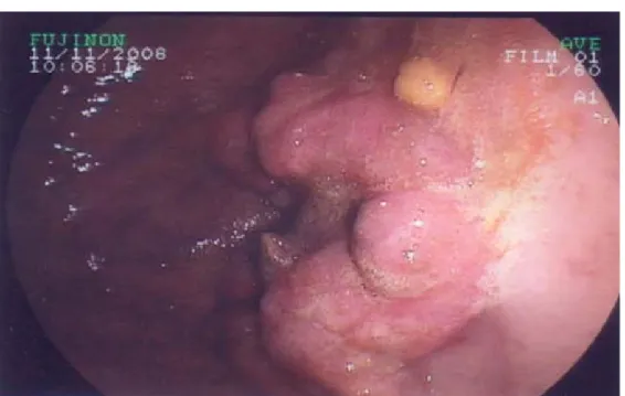 Figure 3: Processus tumoral ulcéro-bourgeonnant infiltrant de siège   antral envahissant le  pylore