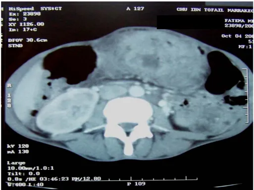 Figure 7 : Coupe scannographique d’une tumeur gastrique localement   avancée envahissant la paroi abdominale antérieure 