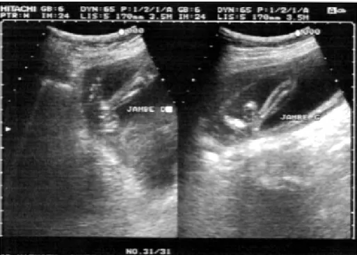 Figure 8 : Echographie anténatal faite à 18 semaines de grossesse objectivant un PBVE droit
