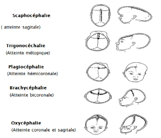 Figure 21: Aspect  morphologique des différents types de crâniosténoses [61 ]  V.  EPIDEMIOLOGIE : 