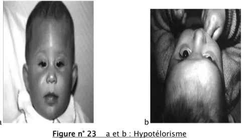 Figure n° 23    a et b : Hypotélorisme 