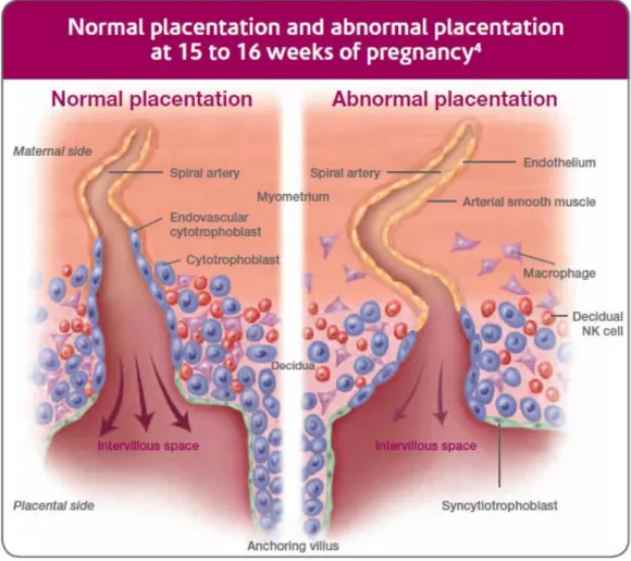 Figure 2 : placentation normale et anormale selon C.W Reedman &amp; IL. Sargent(3). 