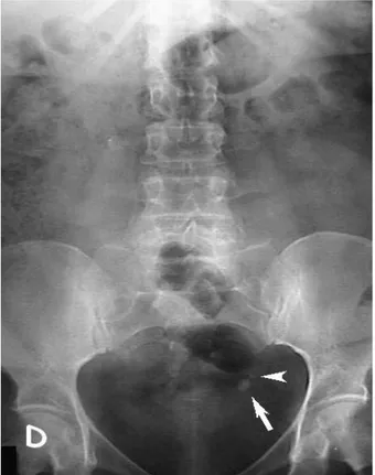 Figure 8 : Arbre urinaire sans préparation qui montre des opacités de tonalité calcique en  projection du trajet de l'uretère pelvien gauche (flèche et tête de flèche)