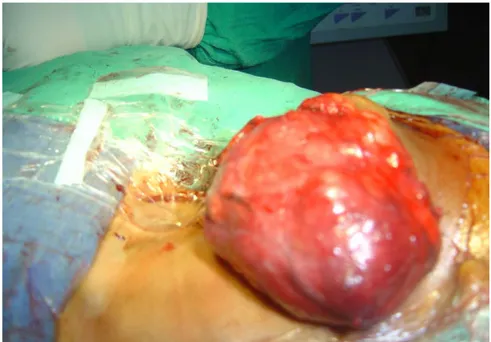 Figure 11: Sous maxillectomie gauche avec exérèse d’une énorme tumeur sous maxillaire
