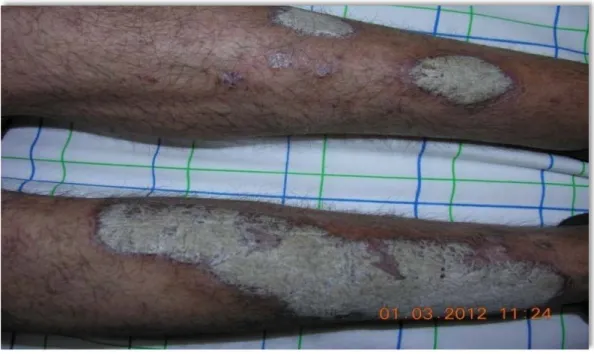 Figure 1 : plaque érythématho-squameuse du psoriasis. 