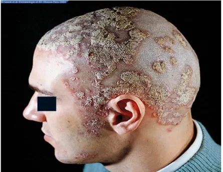 Figure 4 : psoriasis du cuir chevelu [4] 