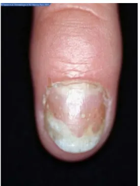 Figure 5 : psoriasis unguéal[4] 
