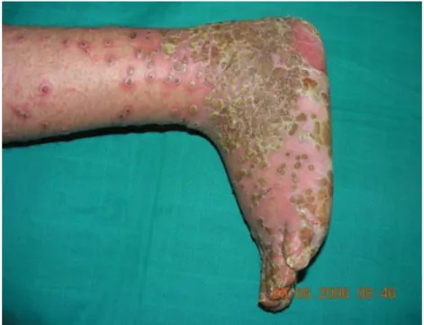 Figure 7 : psoriasis pustuleux 