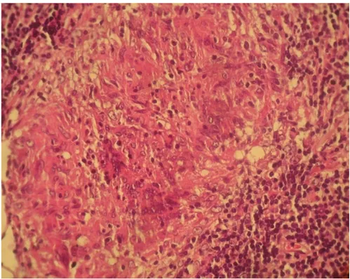 Figure 11 : Coupe histologique montrant une muqueuse nasopharyngée siège   d’un granulome épithélio-giganto-cellulaire avec nécrose caséeuse  