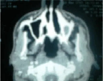Figure 12: TDM de contrôle  (TBK du cavum) montrant la régression totale des lésions  tuberculeuses après traitement anti bacillaire