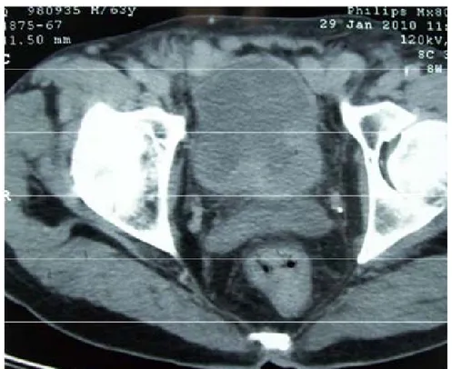 Fig. 2 : retentissement de la tumeur vésicale sur le haut appareil urinaire:  hydronéphrose droite 
