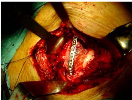 Figure 11 : Fixation d’une fracture de la paroi postérieure du cotyle par plaque spéciale 