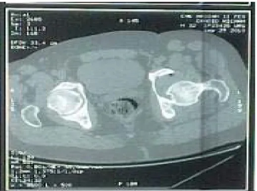 Figure 15 : Facture de la colonne postérieure et de la paroi postérieure,   avec une luxation postérieure de la hanche