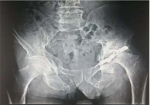 Figure 24 :  Radiographie post-opératoire montrant un ostéonércose de la tête fémorale gauche