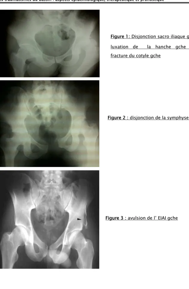 Figure 1: Disjonction sacro iliaque gche ,  luxation de  la hanche gche avec  fracture du cotyle gche 