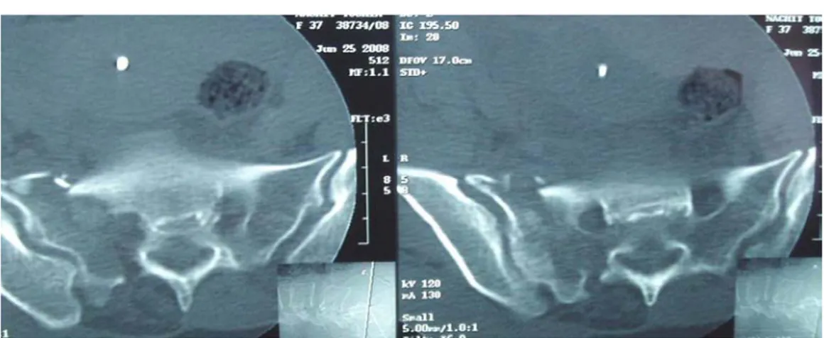 Figure 13 : Coupes coronales d’une TDM pelvienne  Fracture comminutive de l’aileron sacré droit