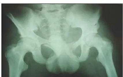 Figure 16 : Radiographie du bassin face Disjonction sacroiliaque droite 