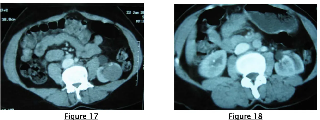 Figure 17 et 18: Uroscanner en coupes axiales successives passant par les reins au temps de  réhaussement cortical, montrant une formation de densité tissulaire polaire inférieure gauche, 