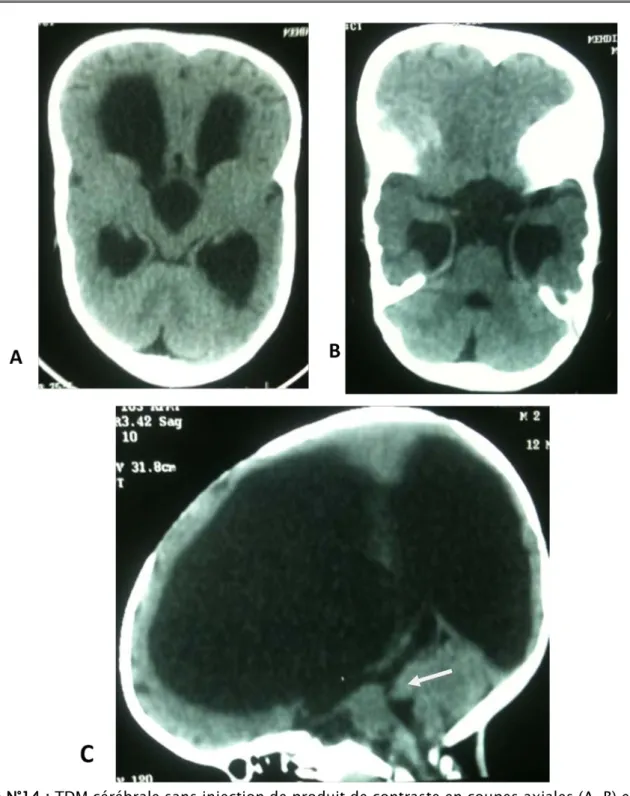 Figure N°14 : TDM cérébrale sans injection de produit de contraste en coupes axiales (A, B) et en  coupe sagittale C montrant une hydrocéphalie triventriculaire en rapport avec une sténose de 