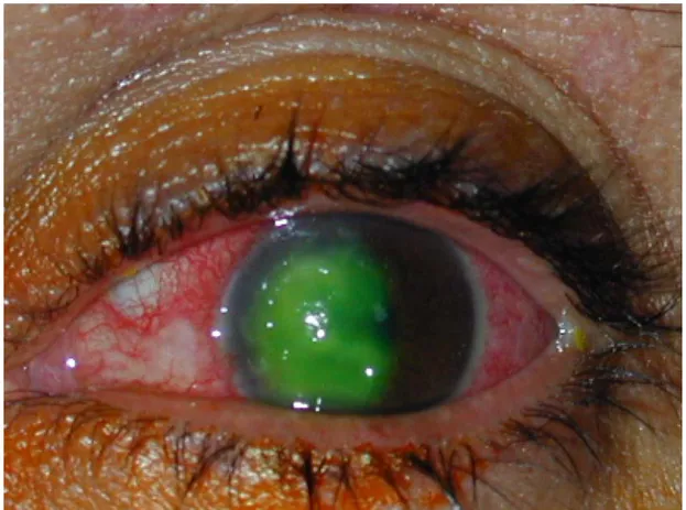 Figure 7: Prise de fluo positive sur abcès de cornée post-traumatique 