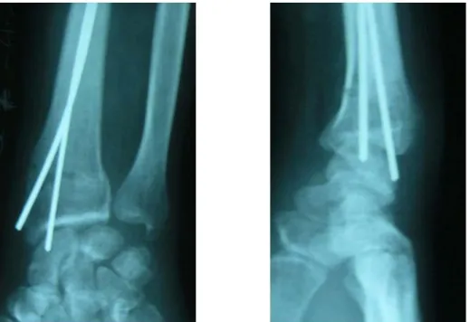 Figure 9 : Brochage élastique selon PY (8) 