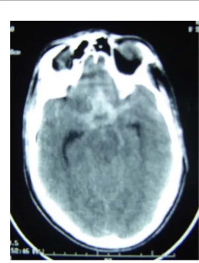 Figure  (18 ) : TDM cérébrale sans injection de produit de contraste en coupe axiales  objectivant une hémorragie méningocérébrale (A et B) prédominant en frontomédiane 