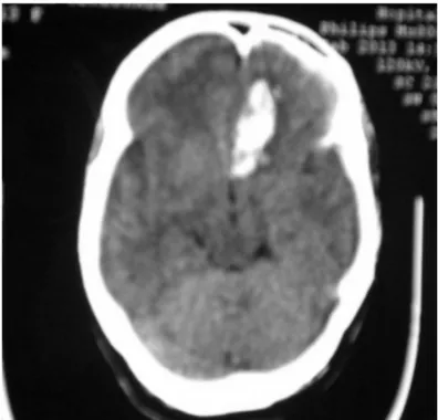 Figure  (39) : Scanner sans injection  montrant une plage hyperdense spontanée sur un scanner  de contrôle demandé suite à une aggravation neurologique chez un patient de 57 ans,    correspondant à  un hématome frontal para sagittal gauche en relation avec le ressaignement 