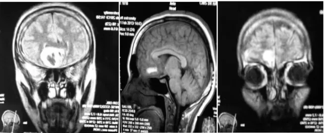 Figure  (52) : IRM encéphalique montrant un hématome frontal parasagittal gauche avec effet de  masse sur la corne frontale homolatérale sans malformation vasculaire visible  chez  une  patiente de 38 ans ayant présentée un syndrome d’HTIC et un syndrome frontal chez qui on a 
