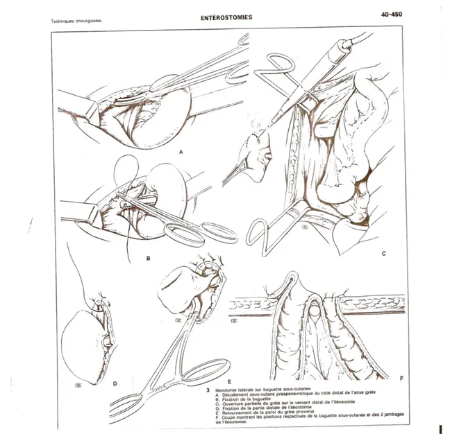 Figure 11 : Schémas montrant la technique de réalisation   d’une iléostomie latérale terminalisée sur baguette [36]