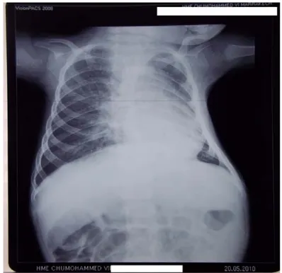 Figure 6 : Radio du thorax de l’enfant D.O. 