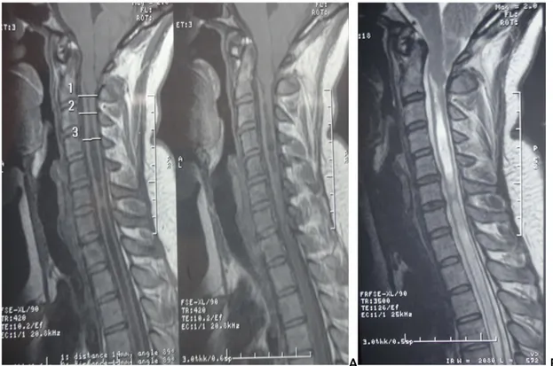 Figure 3 : L’IRM préopératoire montrant une syringomyélie étendue sur malformation d’Arnold  Chiari type 1